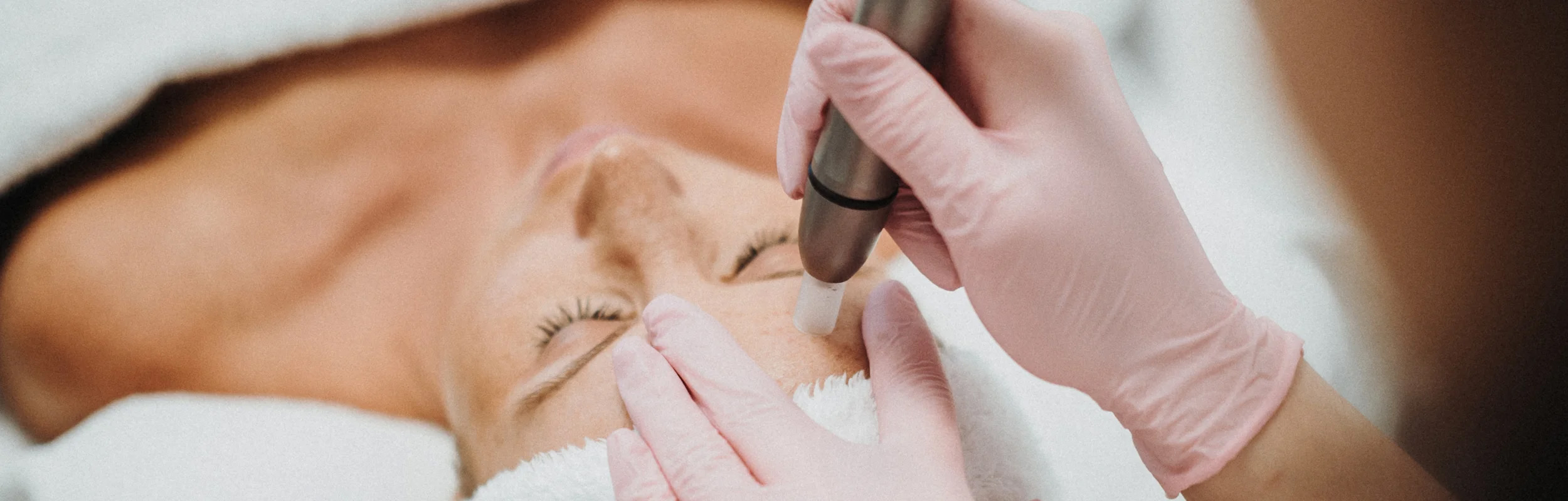 Microdermabrasion: Kosmetikerin mit Handschuhen behandelt die Stirn einer Kundin
